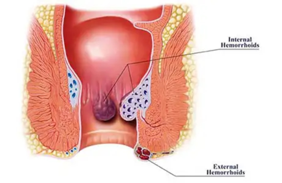 Top Proctology in Dwarka Delhi