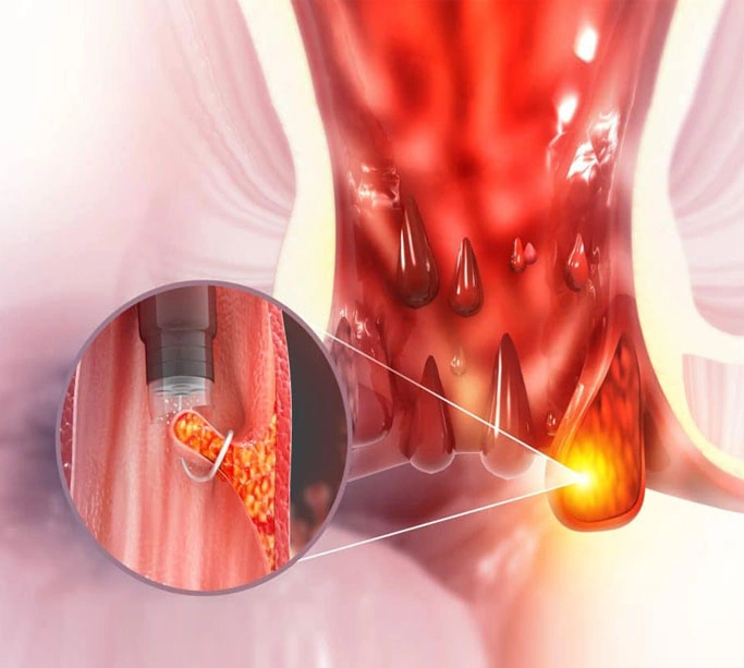 online consultation doctor near me for hemorrhoids