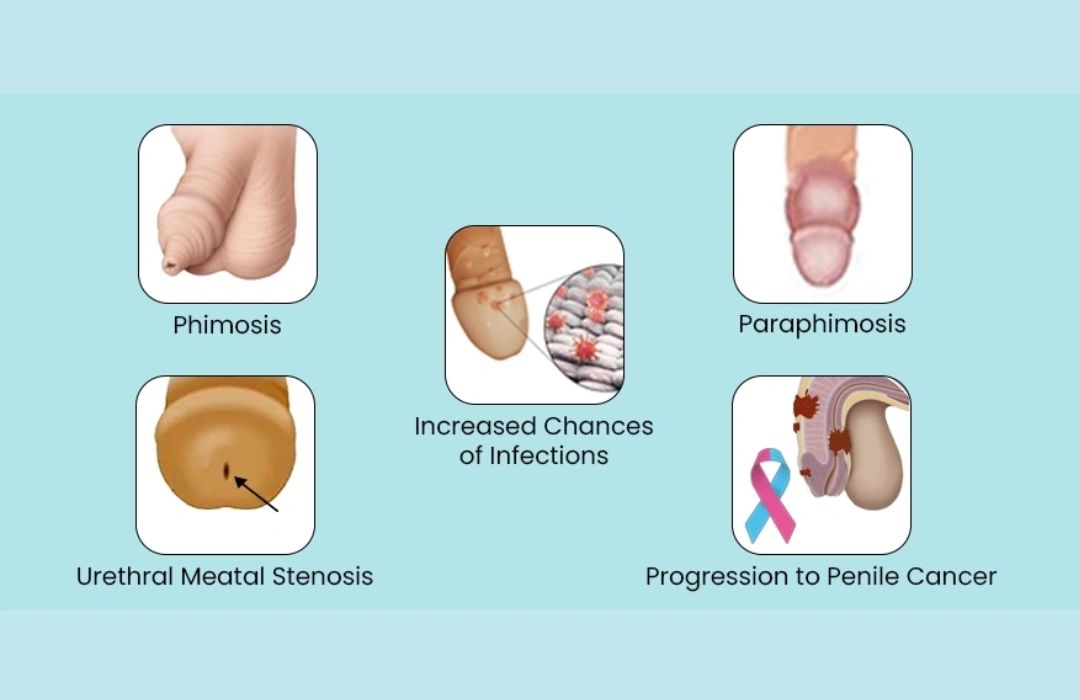 Phimosis risk factors
